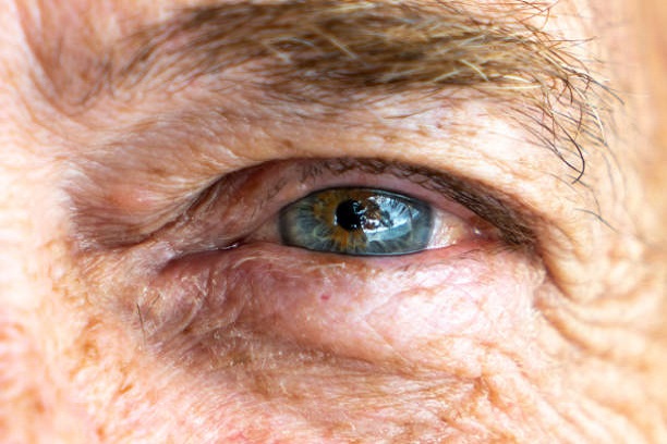 Glaukoma Akut Gejala, Penyebab, Diagnosis, dan Pengobatan